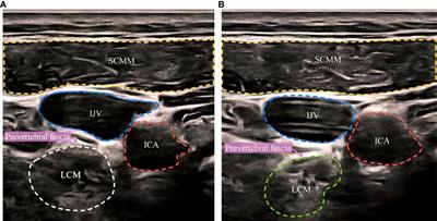 Effects of stellate ganglion block on perimenopausal hot flashes: a randomized controlled trial